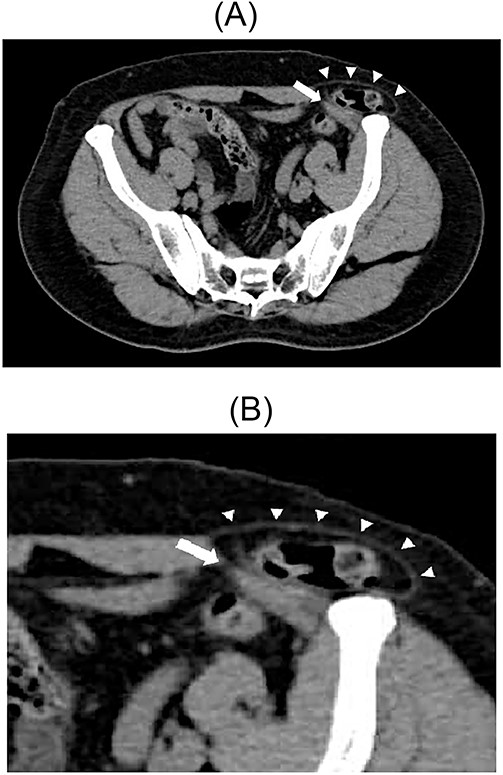 Contrast-enhanced CT scan; the sigmoid colon entered into the layer between the internal and external oblique muscles; the white arrow indicates the internal oblique muscle, and the white triangles indicate the external oblique muscle (A). Enlarged view of the inguinal region (B).