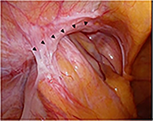 Intraoperative findings; the sigmoid colon entered into the hernial orifice as a sliding hernia; the black triangles indicate the hernial orifice.