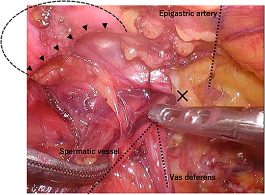 Intraoperative findings of the left inguinal region after peritoneal incision; the black triangles indicate the hernial orifice; the dotted circle indicates the assumed hernia sac; the black cross indicates the internal inguinal ring.