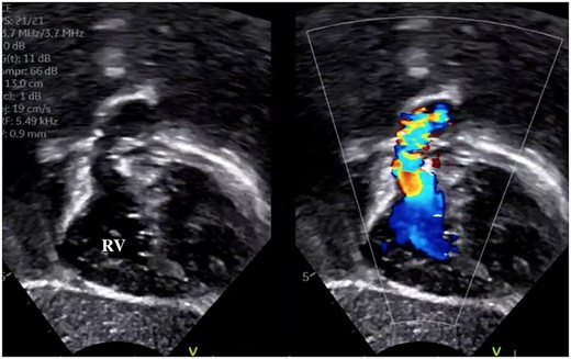 Preoperative transthoracic echocardiography showing right ventricular outflow tract narrowing and jet flow.