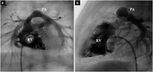 Preoperative cardiac catheterization of the axial view (a) and sagittal view (b) showing PS, with the pulmonary valve annulus diameter of 6.7 mm.