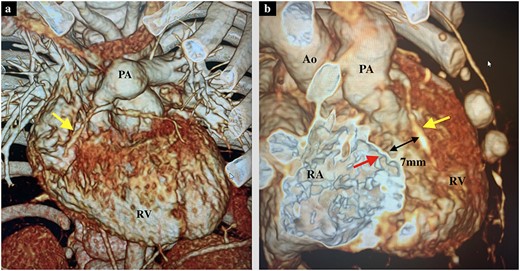 (a) Preoperative 3D-computed tomography of the axial view showing PS and the RCA (yellow arrow). (b) Preoperative 3D-computed tomography of the right oblique view showing the distance between tricuspid valve annulus (red arrow) and RCA (yellow arrow) of 7 mm. Ao, Aorta; RA, right atrium.