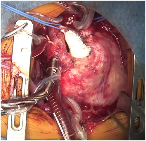 Intraoperative image of a monocuspid valve patch sutured to the PA and right ventricular outflow along the AV groove.