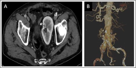 Congenital solitary pelvic kidney (A), aortic carrefour and single renal artery (B).