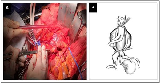 Sequential aortic cross-clamping (A) and schematic representation (B).