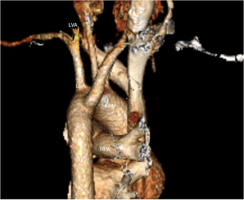 LVA: Left vertebral artery, LSA: left subclavian artery, AL: arteria lusoria, RPA: right pulmonary artery, AoAr: aortic arch.
