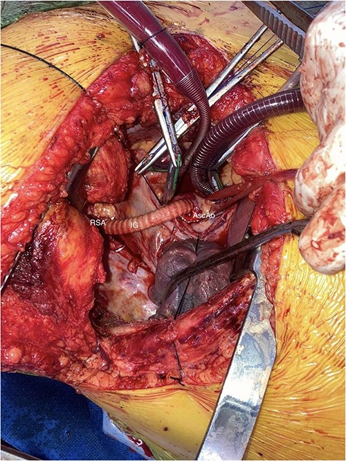 AscAo: ascending aorta, IG: interposition graft, RSA: right subclavian artery.