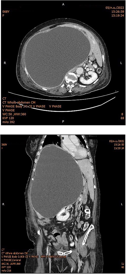 Whole abdomen enhanced CT showed a huge hepatic cyst occupying the right lobe of the liver with intrahepatic bile duct dilatation in the left lobe; the right kidney was displaced into the midline.