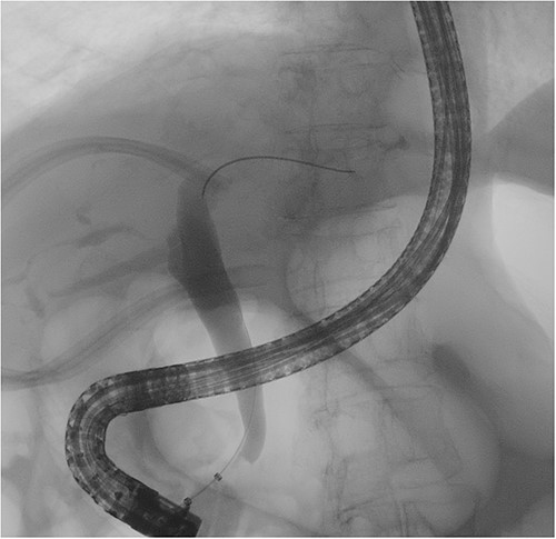 Cholangiography showed a smooth common bile duct wall without intraluminal filling defects.