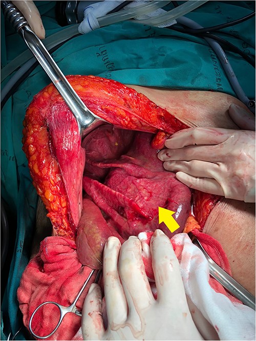 Intraoperative findings showed a collapsed hepatic cyst (arrow) in right liver lobe after cyst fluid was removed.