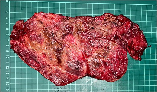 Gross pathology shows the inner surface of cystic wall that was excised.