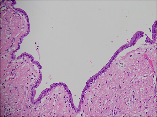 Pathological examination of the resected cyst wall showed a benign cyst lined by cuboidal cells.