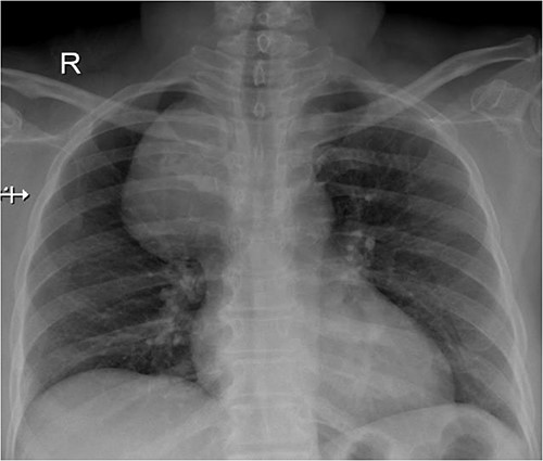 Chest X ray showing space occupying lesion in mediastinum.