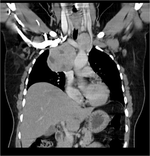 CECT scan showing the right side mass displacing superior nn(SVC).