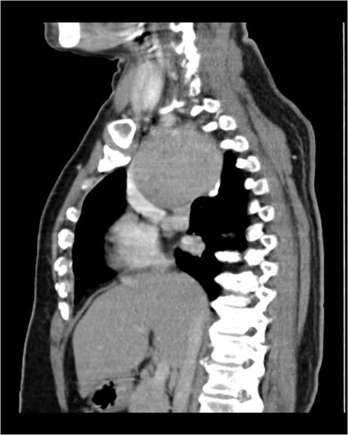 CECT scan showing mass.