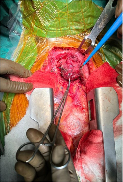 Encapsulated left side mass after sternotomy.