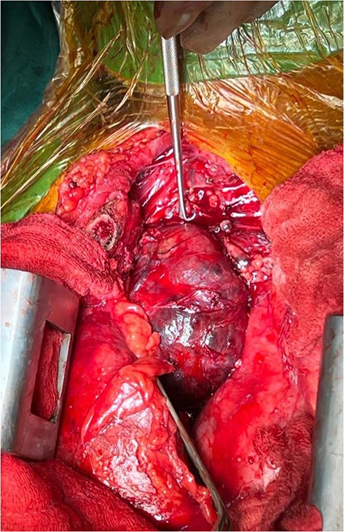Right side mediastinal mass.
