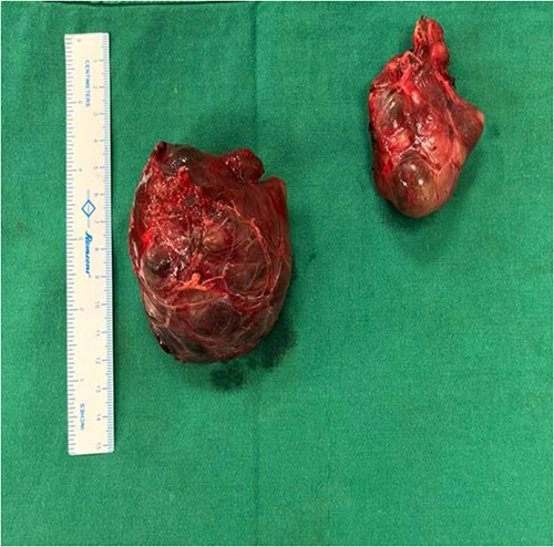 Mediastinal mass after excision.
