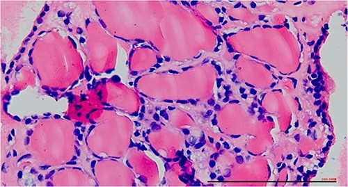 Excised mass with thyroid follicles.