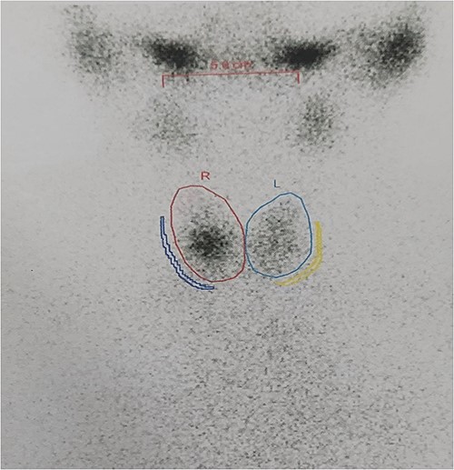 Thyroid scan showing ortho-topic thyroid with no uptake anywhere else.