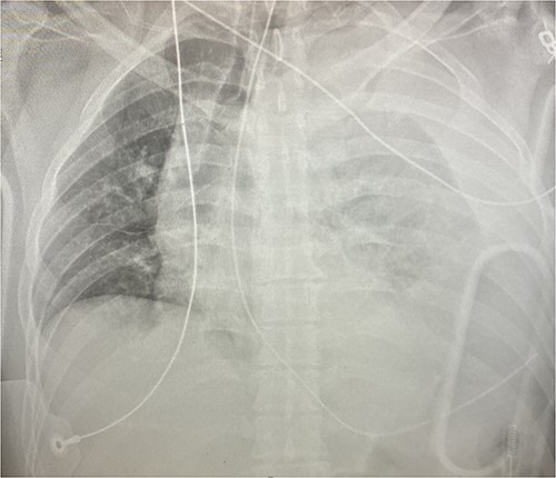 Chest x-ray demonstrating left hemothorax.