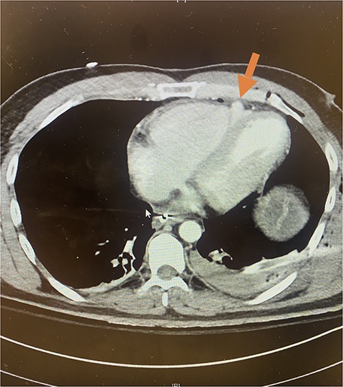 Axial CT imaging demonstrating pseudoaneurysm of right ventricular free wall rupture.