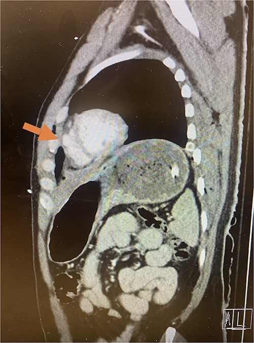 Sagittal CT imaging demonstrating pseudoaneurysm of right ventricular free wall rupture.