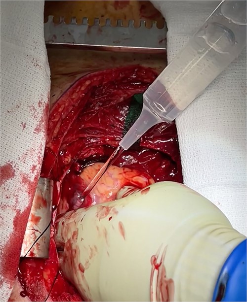 Intraoperative photo demonstrating extravasation from ventricular rupture.