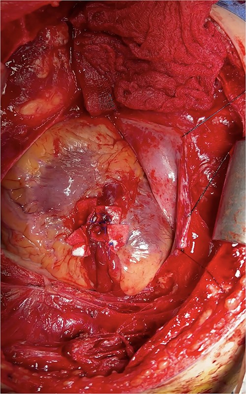 Intraoperative photo demonstrating pledgeted horizontal mattress repair of ventricular rupture.