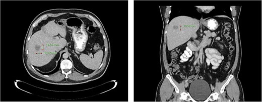 Computed tomography dated 25 September 2012 of the abdomen and pelvis measuring 18.65 mm (anterior–posterior) lesion at liver segment 5/6 in axial (left) and coronal (right) view.