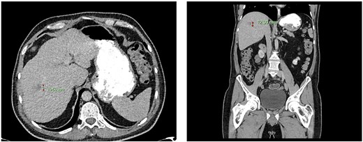 Computed tomography dated 15 January 2013 of the abdomen and pelvis measuring 10.50 mm (anterior–posterior) lesion at liver segment 5/6 in axial (left) and coronal (right) view.