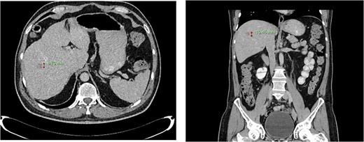 Computed tomography dated 12 March 2013 of the abdomen and pelvis measuring 8.70 mm (anterior–posterior) lesion at liver segment 5/6 in axial (left) and coronal (right) view.