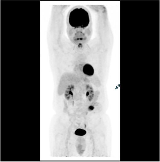 PET scan in 2018 demonstrating no evidence of FDG avid regional nodal or distant metastasis, especially in the liver.