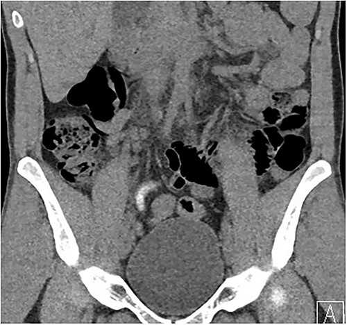 Coronal imaging, demonstrating contrast-filled vermiform structure.