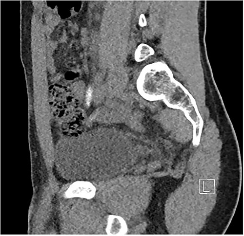 Sagittal imaging, depicting the base of structure arising from the caecum.