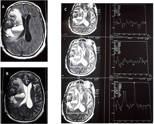 (A) Preoperative T1 weight. (B) T2-weighted MRIs. (C) Preoperative magnetic resonance spectroscopy.