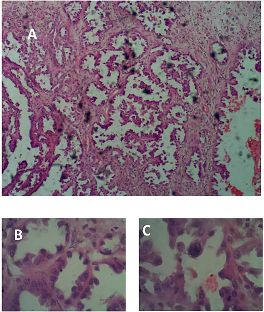 (A) Photomicrograph showing arborizing neoplastic papillae H&E × 40. (B) H&E × 100. (C) Showing high-grade neoplastic cells lining delicate fibrovascular cores, H&E × 400.