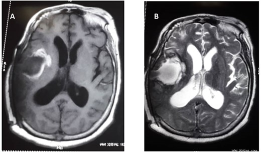 Post-operative MRIs T1 weight (A) and T2 weighted (B).