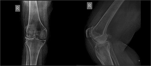 Preoperative X-rays demonstrating stage IV OA.