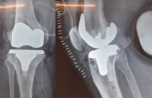 Medial-pivot TKA.