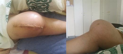 Clinical presentation of tibiofemoral dislocation following TKA.