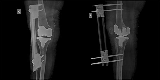 X-rays 1-month after external fixation.