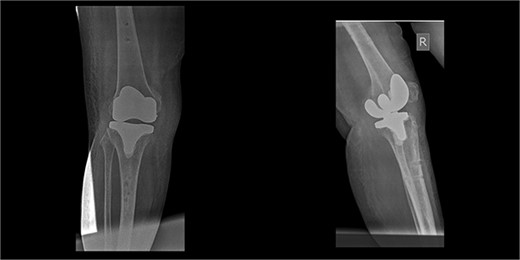 X-rays 3-weeks post removal of external fixator.