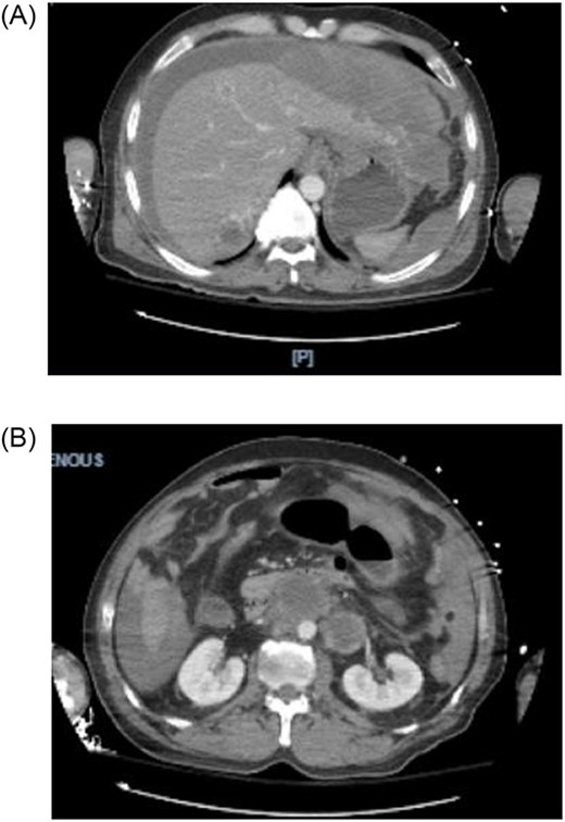 (A, B) CTA shows hemoperitoneum anterior to the left lobe of the liver.