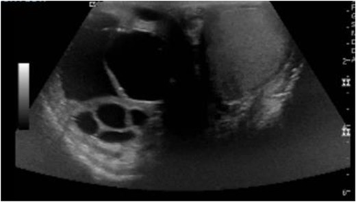 Right scrotum complex cystic mass.