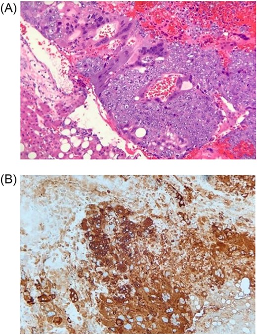 (A) Histologic section showing mononucleated trophoblast and multinucleated syncytiotrophoblast cells consistent with choriocarcinoma (Hematoxylin and eosin stain); (B) Immunohistochemistry for human chorionic gonadotropin (hCG) highlights tumors cells, which supports the diagnosis of choriocarcinoma (Immunohistochemical stain).
