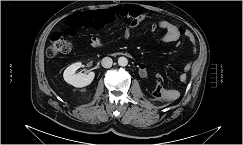 Abdominal CT imaging. Absence of left kidney from its usual anatomic position.