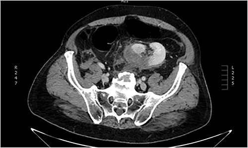Abdominal CT imaging. Ectopic (pelvic) left kidney. Presence of grade III laceration without collecting system rupture or urinary extravagation.