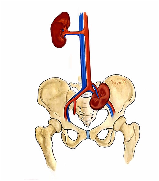 Anatomic illustration. Location of the pelvic kidney below the aortic bifurcation.