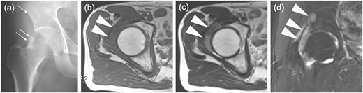 Images before the arthroscopic surgery. (a) A radiograph showed the calcification at the anterolateral side of the right femoral neck (two arrows) and a radiolucent shadow of the pelvic bone (an arrow). Axial (b) T1-, (c) T2-weighted image (T1WI, T2WI) and (d) coronal T2 fat-saturated (T2 fs) image revealed the intra-articular lesion in the right hip joint (two headless arrows). The mass was 40mm×10mm×42mm and isointense, heterogenous and hyperintense to skeletal muscle on T1WI and T2WIand T2 fs images respectively. T2WI showed triple signal intensity sign9. In addition, the coronal T2 fs image showed a pelvic bone lesion (a headless arrow).
